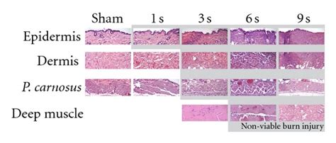 Improving the histologic characterization of burn depth